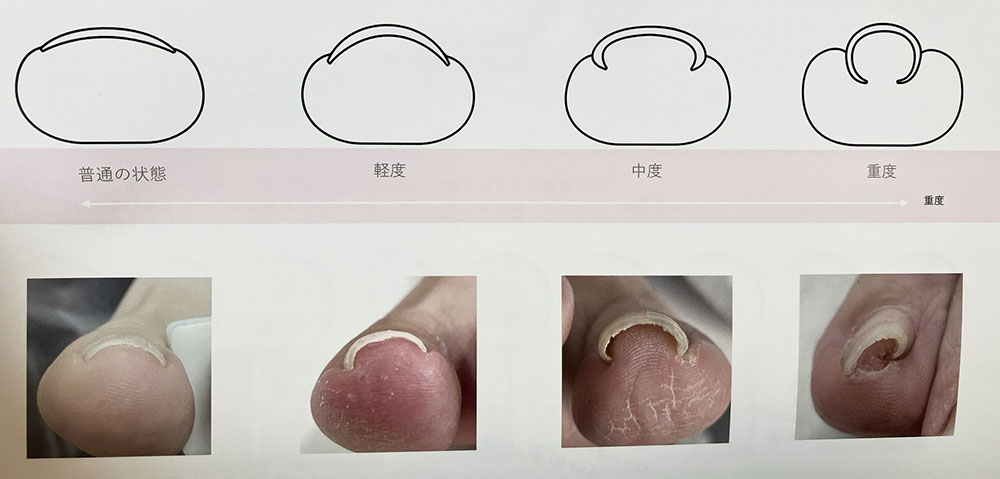 巻き爪の状態（普通・軽度・中度・重度のイメージ）