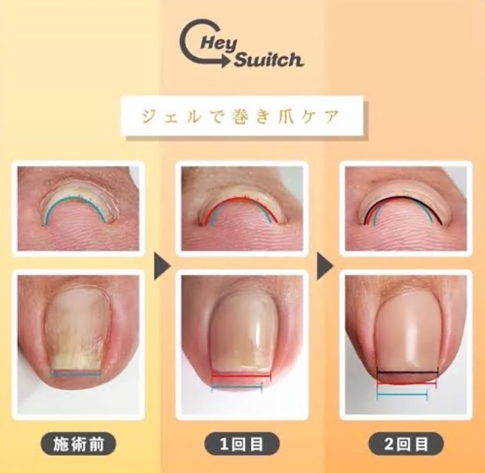 ジェルで巻き爪ケア（施術前・1回目・2回目のイメージ）